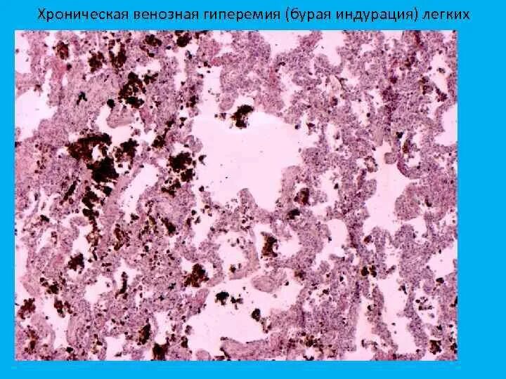 Хроническая венозная гиперемия. Мускатная печень гистология. Мускатный цирроз печени микропрепарат. Хроническая венозная гиперемия. Венозное полнокровие печени.