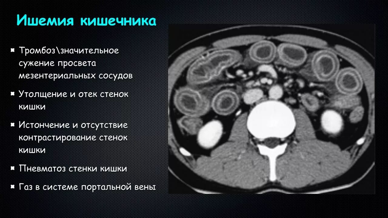 Диффузное утолщение стенок. Тромбоз мезентериальных сосудов на кт. Тромбоз верхней мезентериальной вены. Мезентериальные сосуды кт.