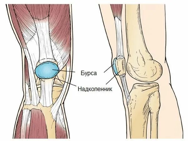 Бурсит коленного сустава что это такое. Препателлярный бурсит. ретропателлярный бурсит. инфрапателлярный бурсит. бурсит коленного сухожилия.