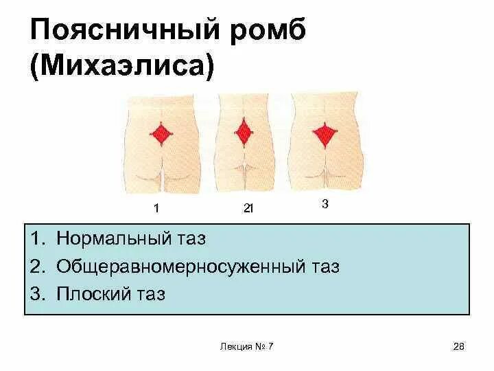 Ромб михаэлиса в акушерстве измерение. Ромб михаэлиса норма. Пояснично крестцовый ромб михаэлиса норма. Верхний угол ромба михаэлиса. Ромб михаэлиса в акушерстве.