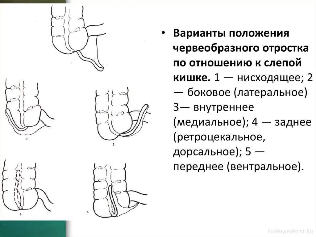 Аппендикс червеобразный. Атипичные локализации аппендикса. Червеобразный отросток анатомия расположение. Схема расположения червеобразного отростка. Типы расположения аппендикса.