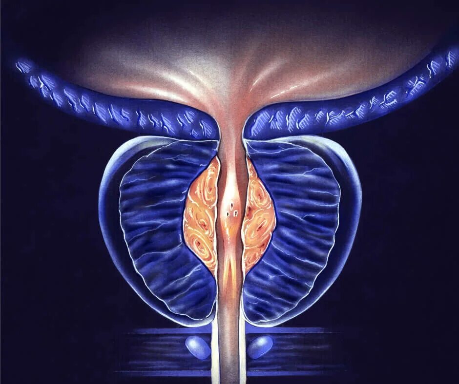 Предстательная железа методы лечения. Простатит предстательной железы. Простатит и аденома простаты. Простата рисунок. Простатит креатив.