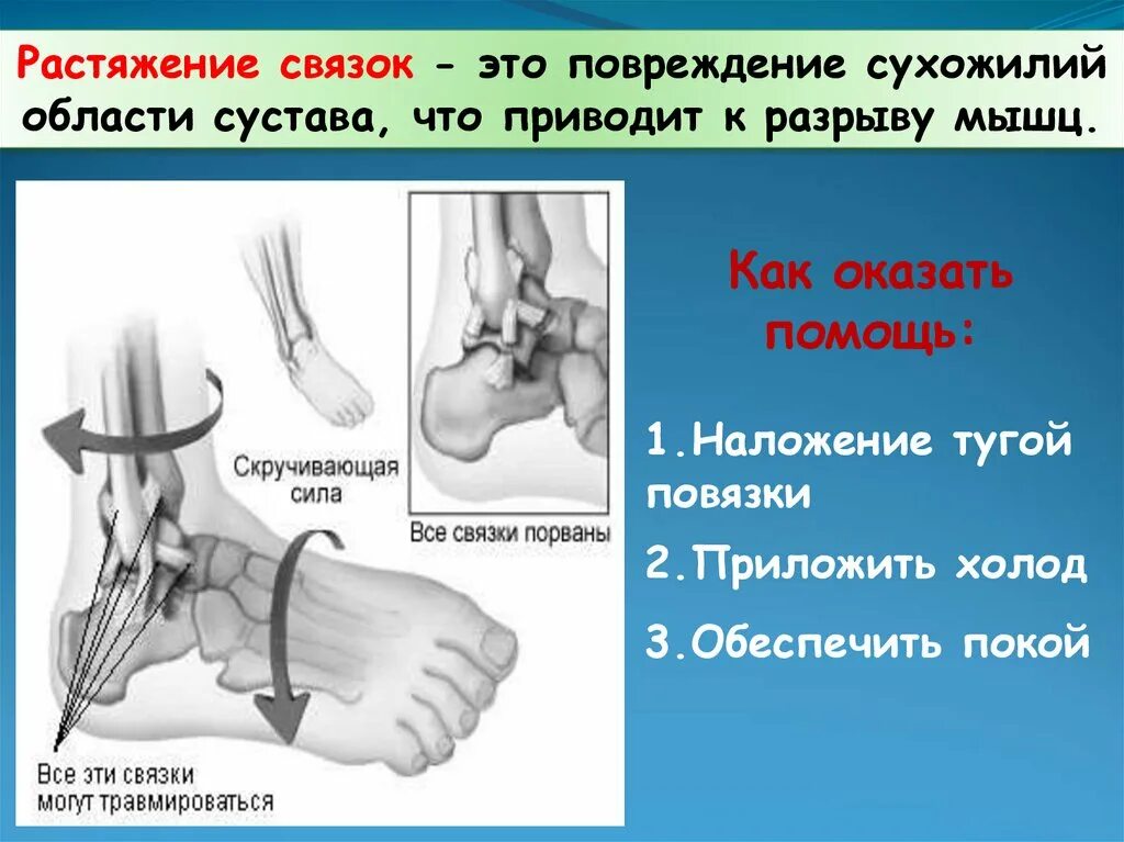 Растяжения, повреждения связок.. Растяжение определение. Разрыв сухожильных связок. Растяжения и разрывы связок суставов.