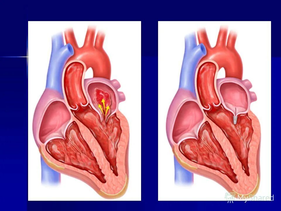 Что такое пролапс митрального клапана. Недостаточность митрального клапана регургитация. Пролапс двустворчатого клапана. Пролапс сердца 1 степени.