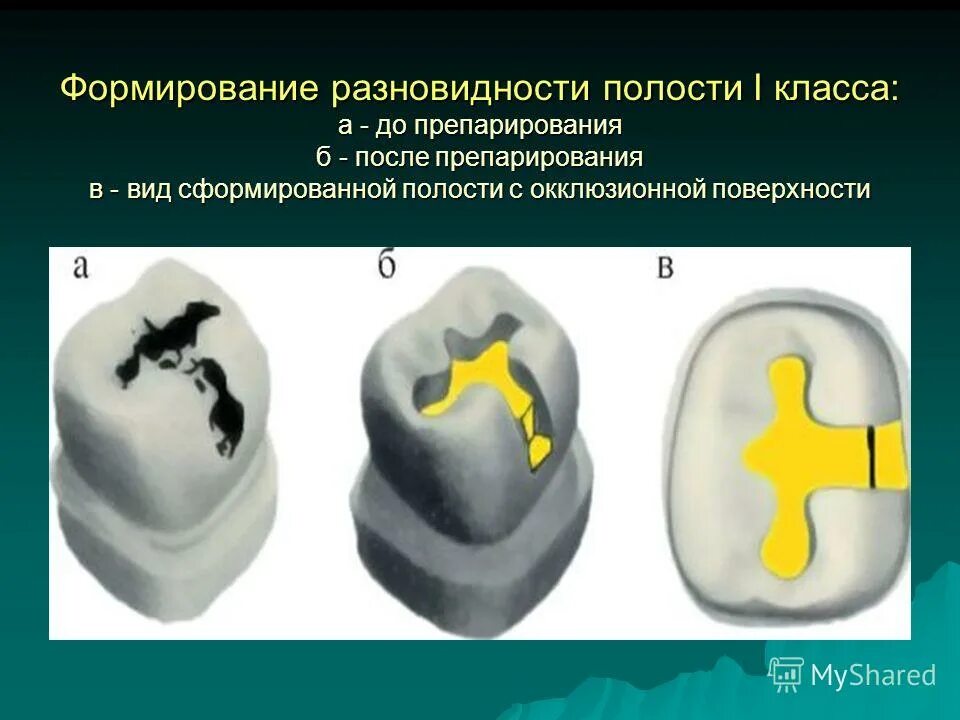 Препарирование полостей по блэку. Препарирование полости 1 класса. варианты препарирования полостей i класса по блеку. формирование кариозной полости 1 класса по блэку. формирование полостей по блэку.