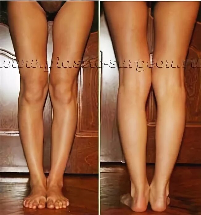 Какие должны быть ноги. Круглые коленки у женщин. Нормальные ноги у взрослых. Форма ног коленями внутрь.