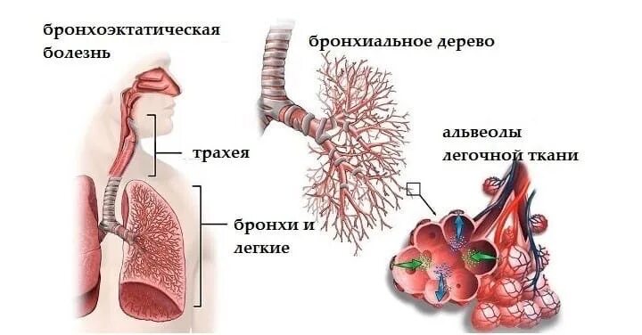 Мокрота в бронхах. Степени тяжести бронхоэктатической болезни. бронхоэктатическая болезнь мокрота. бронхоэктатическая болезнь легких осложнения. расширение мелких бронхов.
