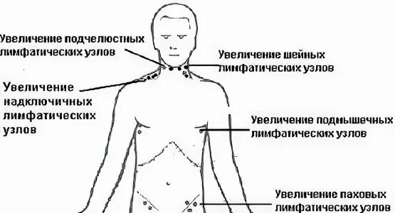 Лимфоузлы в паху воспаление причины лечение. Надключичные и подключичные лимфоузлы. Надключичные лимфоузлы расположение. Схема расположения надключичных лимфоузлов. Надключичные лимфоузлы расположение расположение.