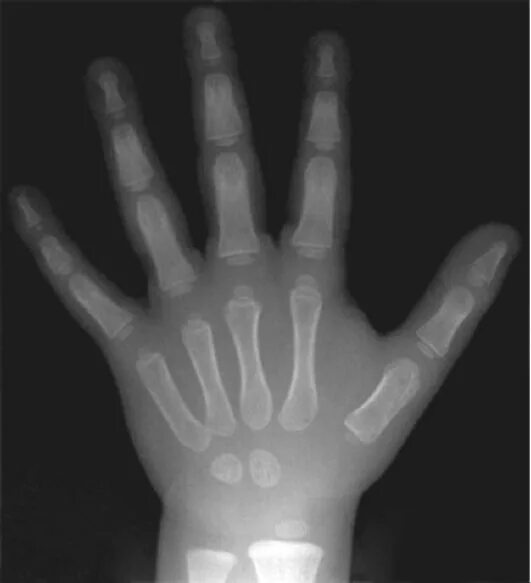 рентгенограмма кистей рук. снимок кисти руки. костный возраст рентген кисти. рентген кисти ребенка 1 год. рентген кисти рук ребенка.
