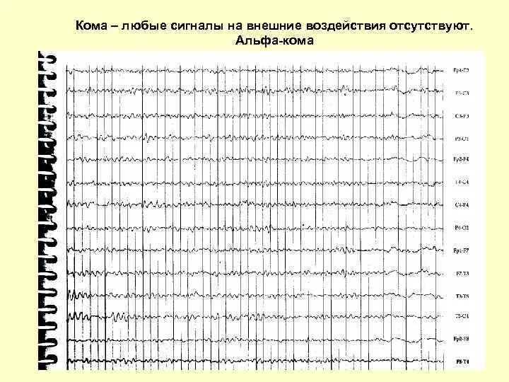 Альфа кома на ээг. Альфаком москва. Электроэнцефалография синдром стерджа вебера. Electrocerebral silence. Альфакома.