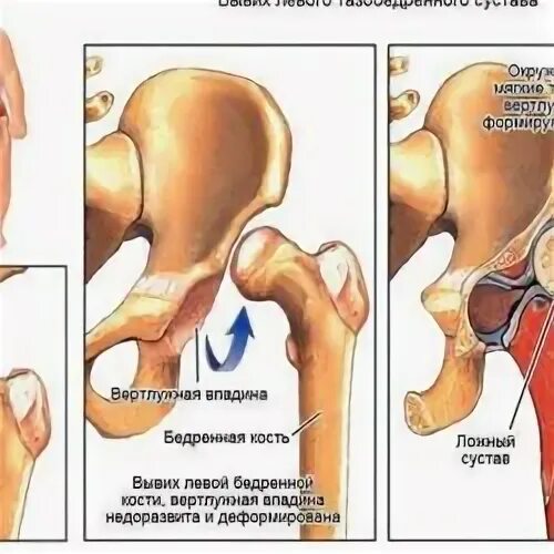 Подвывих тазобедренного сустава симптомы и лечение. Подвывих тазобедренного сустава у взрослых. вывих тазобедренного сустава у взрослых. подвывих тазобедренного сустава у взрослых симптомы. вывих тазобедренного сустава у взрослых симптомы.