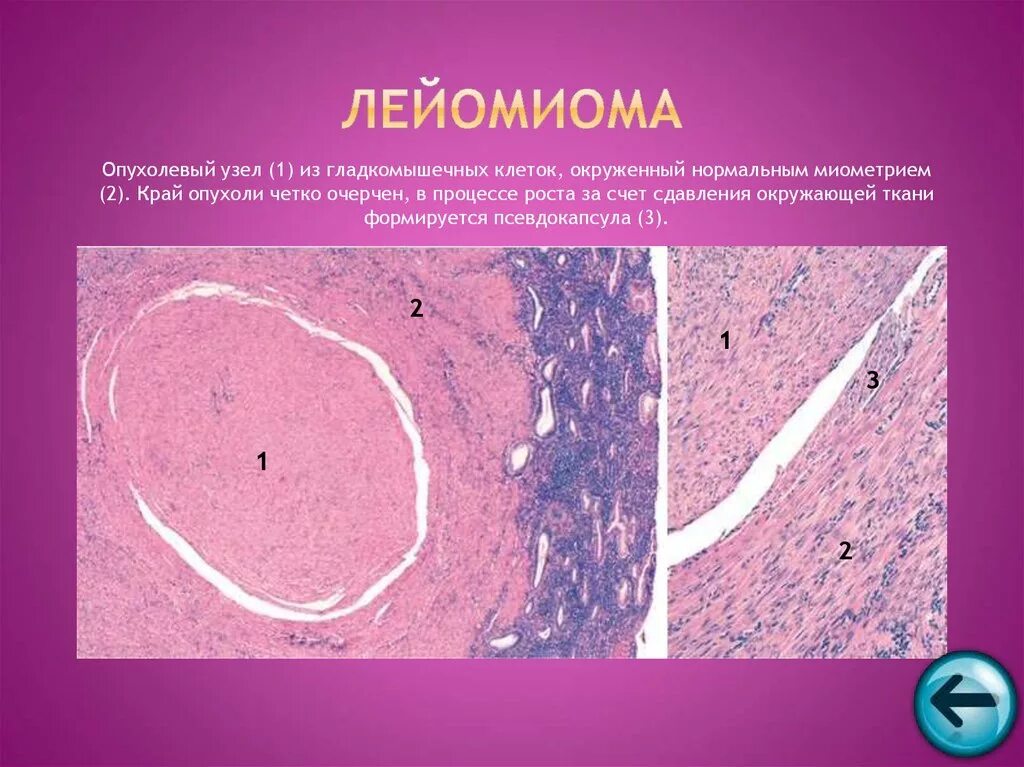 Рак матки препарат. Лейомиома матки гистология. Микропрепарат злокачественная лейомиома. Миоматозный узел матки гистология. Клеточная лейомиома матки гистология.
