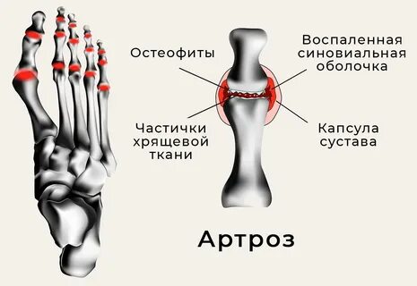 Межфаланговый артроз стопы