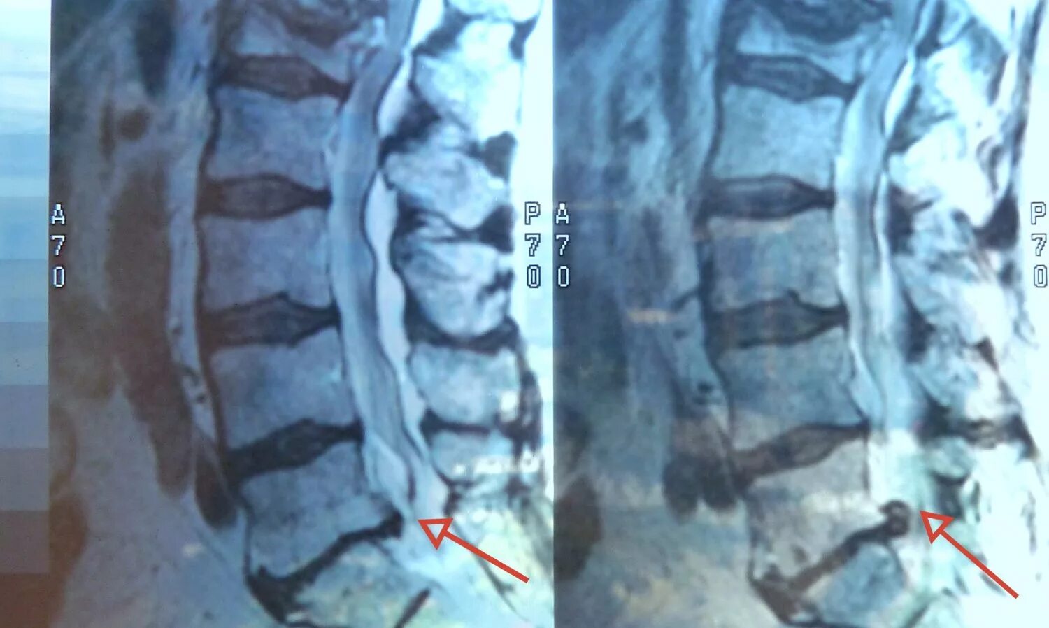 Дегенеративный стеноз позвоночного канала l4-l5. Стеноз позвоночного канала l4-l5. Межпозвонковые диски l5-s1. Межпозвонковый диск l5-s1. Позвоночная грыжа l1-l2.
