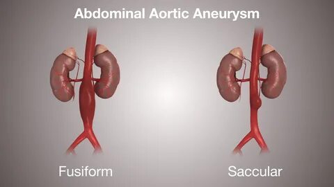 Abdominal aortic aneurysm