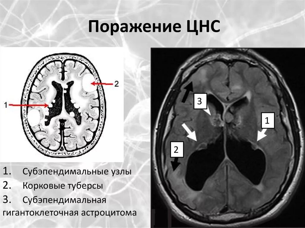 Резидуальное поражение мозга. Повреждение центральной нервной. Поражение нервной системы. Болезни поражающие ЦНС.