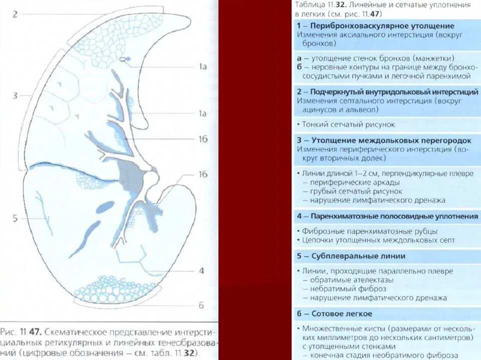 Что означает фиброзное изменение. Утолщение перибронховаскулярного интерстиция кт. Междольковые перегородки утолщены. Уплотнение в легких на кт. Утолщение междольковых перегородок в легких на кт.