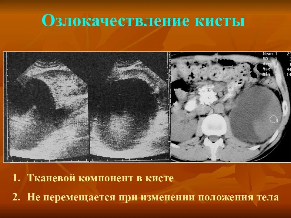 Кистозный солидный образование молочные железа. Доброкачественная киста. Киста с пристеночным компонентом. Солидный компонент в кисте молочной железы что это.