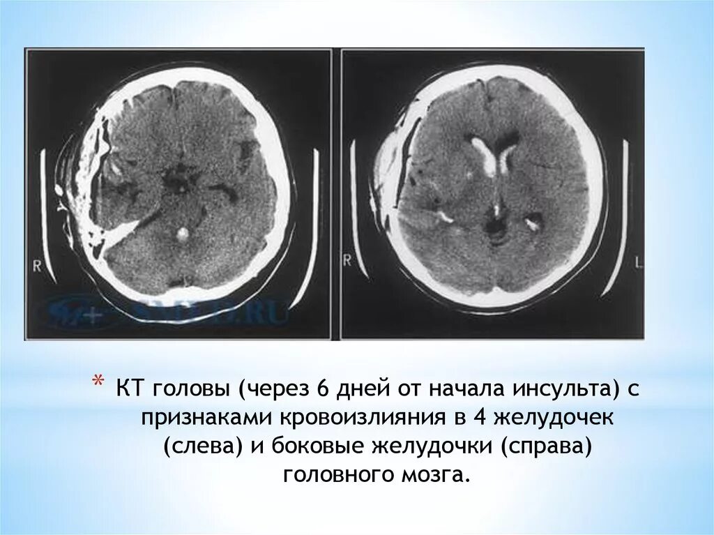 Кровоизлияние в желудочки. Геморрагический инсульт головного мозга кт. Геморрагический инсульт мозжечка на кт. Геморрагический инсульт субарахноидальное кровоизлияние кт. Кровоизлияние в желудочки кт.