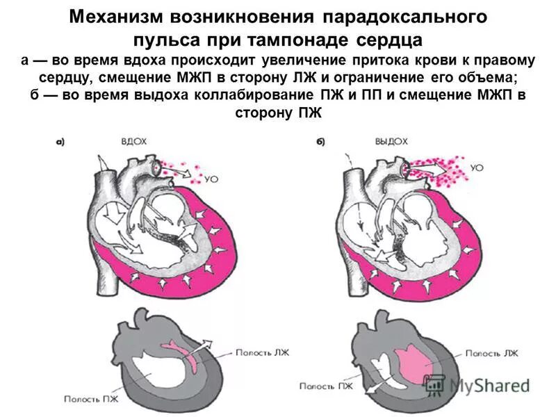 парадоксальный пульс при перикардите.