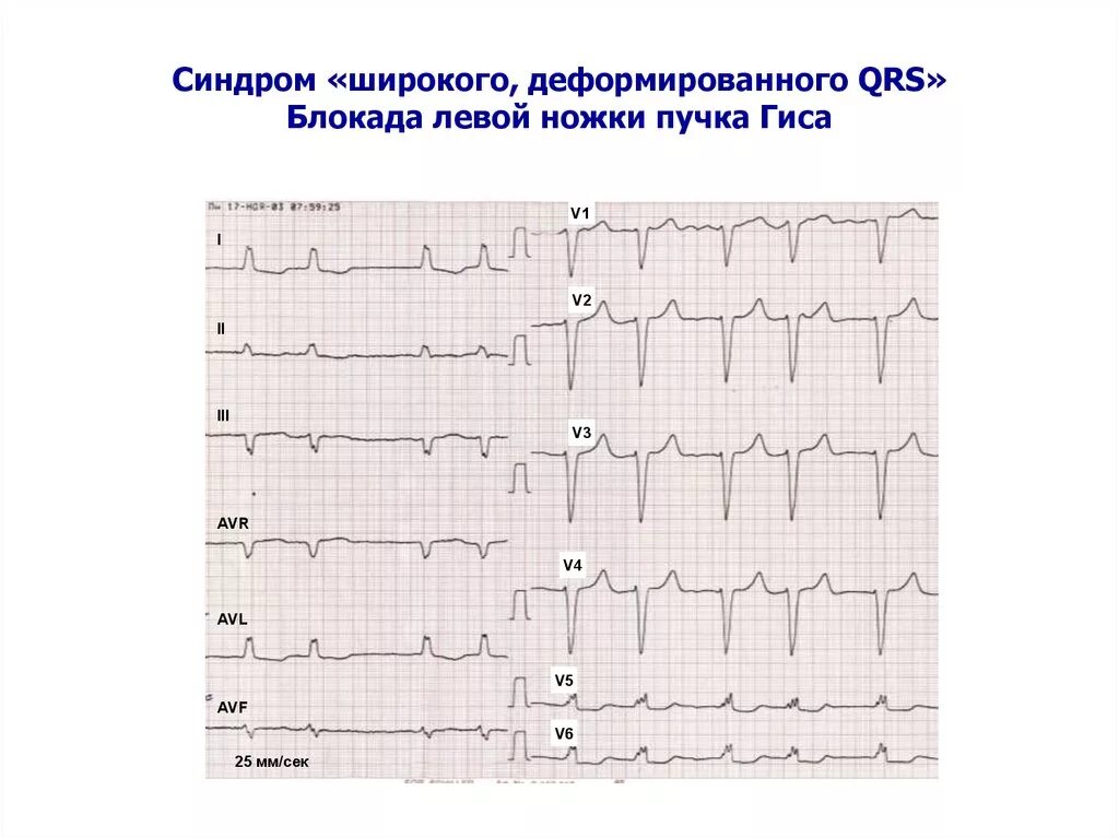 Блокада ЛНПГ на ЭКГ. Пленка ЭКГ С блокадой левой ножки пучка Гиса. Полная блокада ЛНПГ на ЭКГ. Полная блокада левой ножки п Гиса на ЭКГ. Левая ножка п гиса