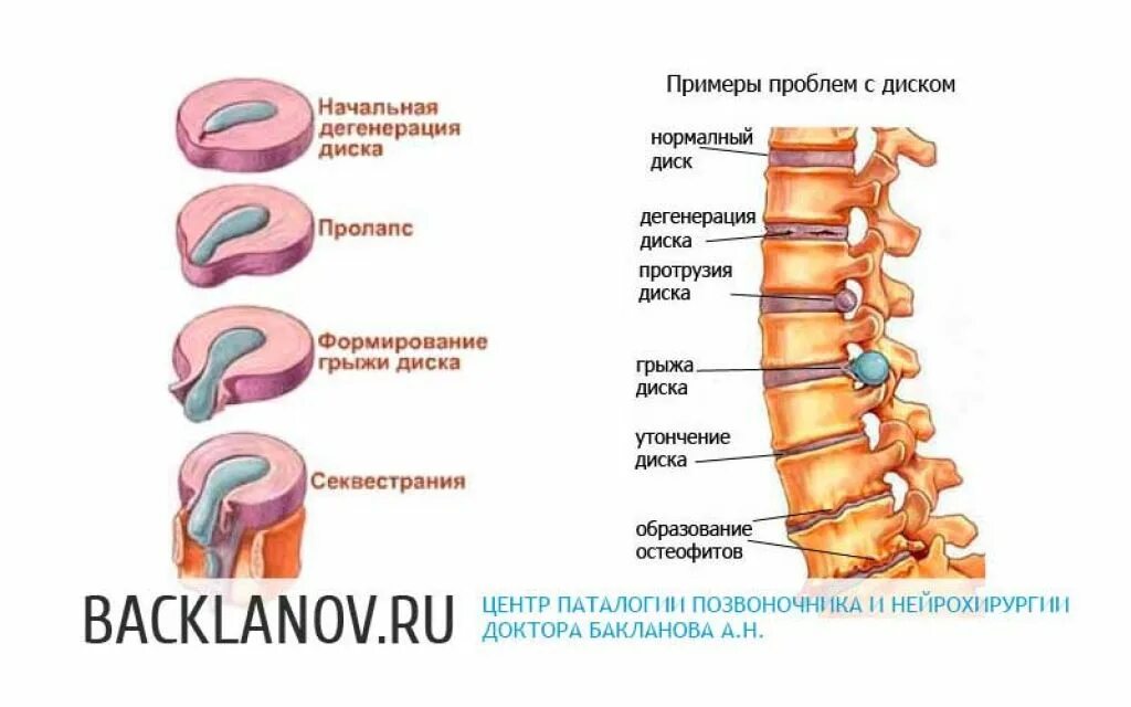 Как лечить грыжи и протрузии позвоночника. Протрузия грыжа диска позвоночника. протрузии дисков позвоночника схема. дегенерация диска позвоночника. протрузия дисков с3-с7.