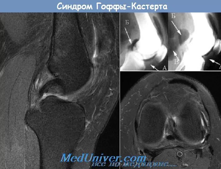 Отек гоффа коленного сустава. Киста жирового тела Гоффа. Киста клетчатки Гоффа мрт.