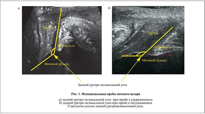 Мочевой пузырь остаточная моча норма. Уретровезикальный угол. Уретровезикальный угол по УЗИ. Уретровезикальный сегмент. Трансперинеальное УЗИ.