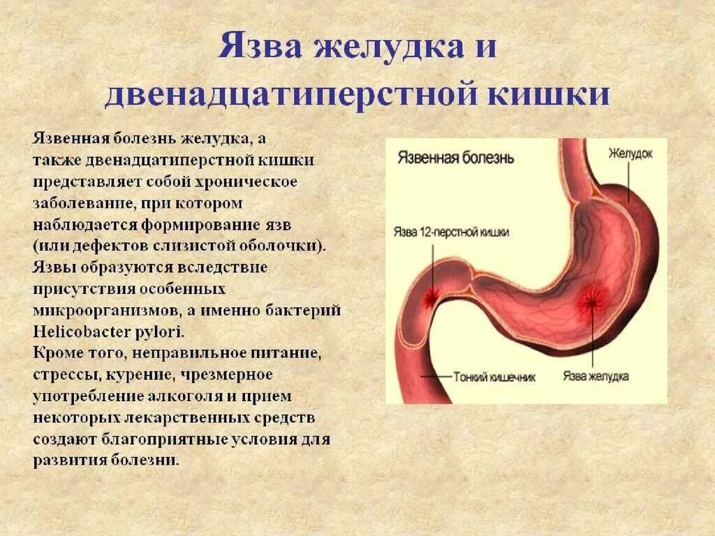 Язвенная болезнь желудка и 12 перстной. Язвенная болезнь желудка и 12 перстной кишки. Основные симптомы язвенной болезни желудка и 12-перстной кишки. Язвенная болезнь 12 перстной кишки симптомы. Язва симптомы и лечение у взрослых