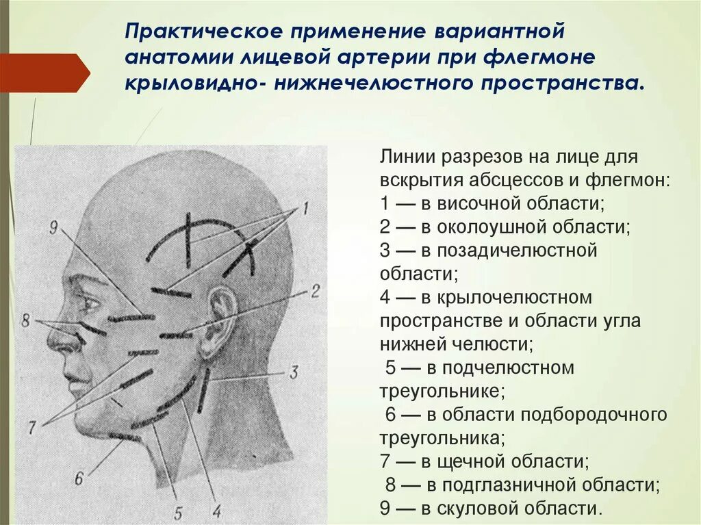 Абсцесс челюстного пространства. Схема рудько флегмон. крыловидно-нижнечелюстное пространство. флегмона крыловидно-нижнечелюстного пространства. вскрытие флегмоны крыловидно челюстного пространства.