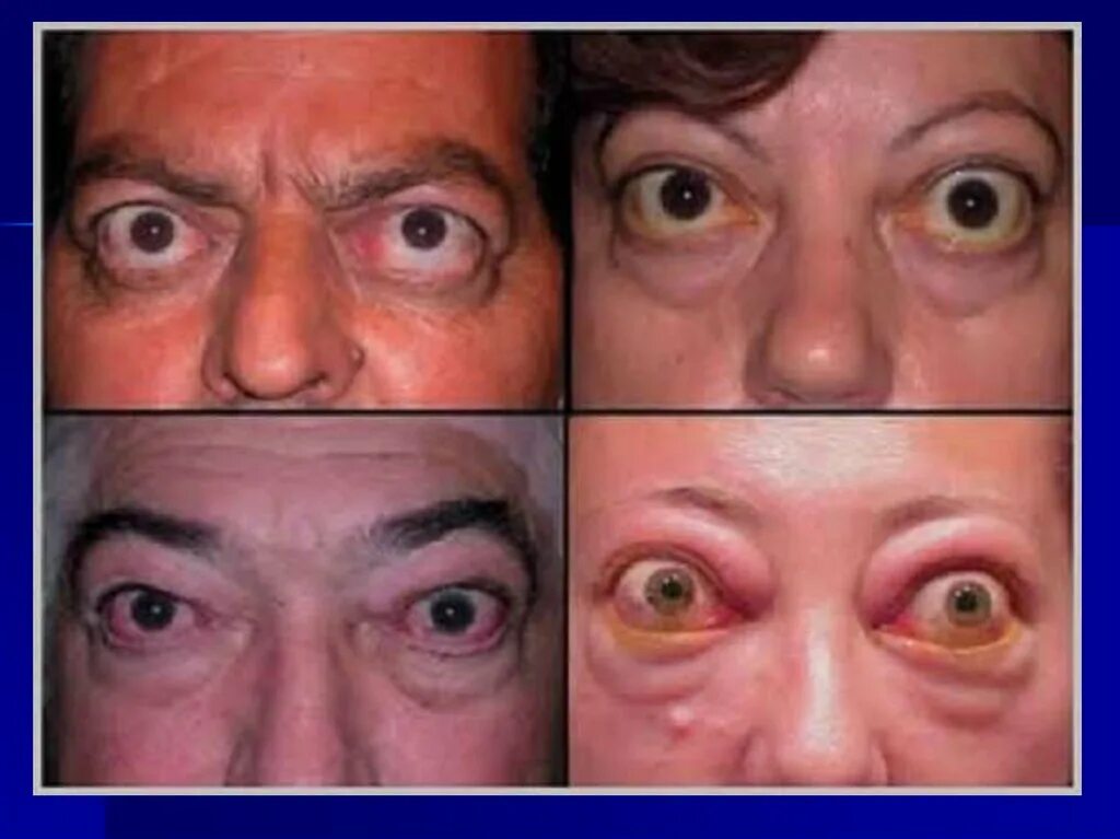 Офтальмопатия Грейвса. Тиреотоксикоз офтальмопатия. Эндокринная офтальмопатия. Почему вылазит глаз