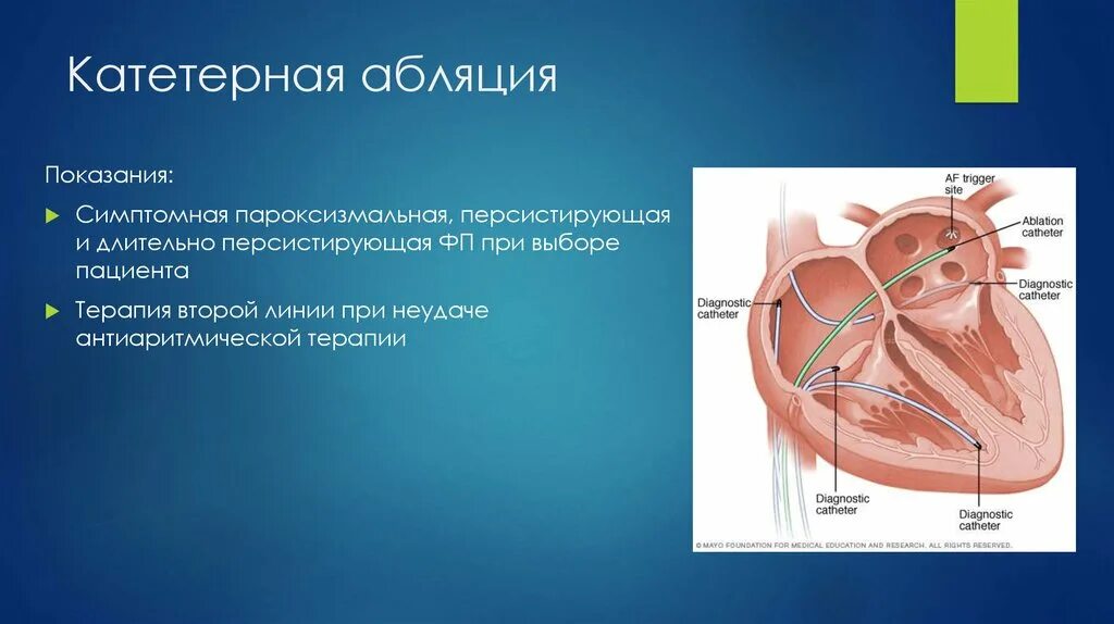 Где делают абляцию. Радиочастотная катетерная абляция. Катетерная абляция фибрилляции предсердий. Радиочастотная катетерная абляция фибрилляции предсердий.