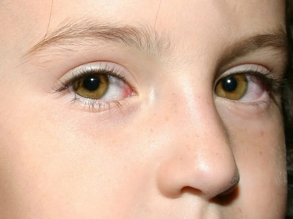 Генезис глазная. Синдром Александрии. Люди с фиолетовыми глазами Генезис Александрии. Сиреневые глаза у людей. Фиолетовые глаза от природы.