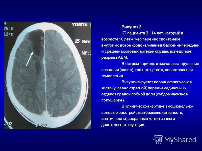 Внутримозговое кровоизлияние мкб. Внутримозговое кровоизлияние мкб. Классификация нарушений мозгового кровообращения неврология. Последствия онмк диагноз мкб. Онмк диагноз мкб.