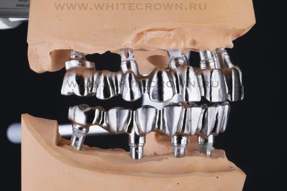 Имплантация 6 in 1