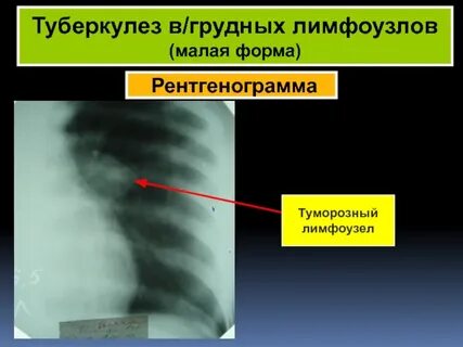 Туберкулез форум
