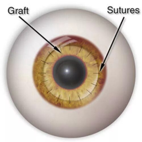 Донор глаза. Кератопластика роговицы глаза. Глаз после кератопластики. Кератопластики в офтальмологии. Кератопластика операция.