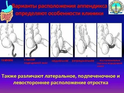 Виды аппендикса
