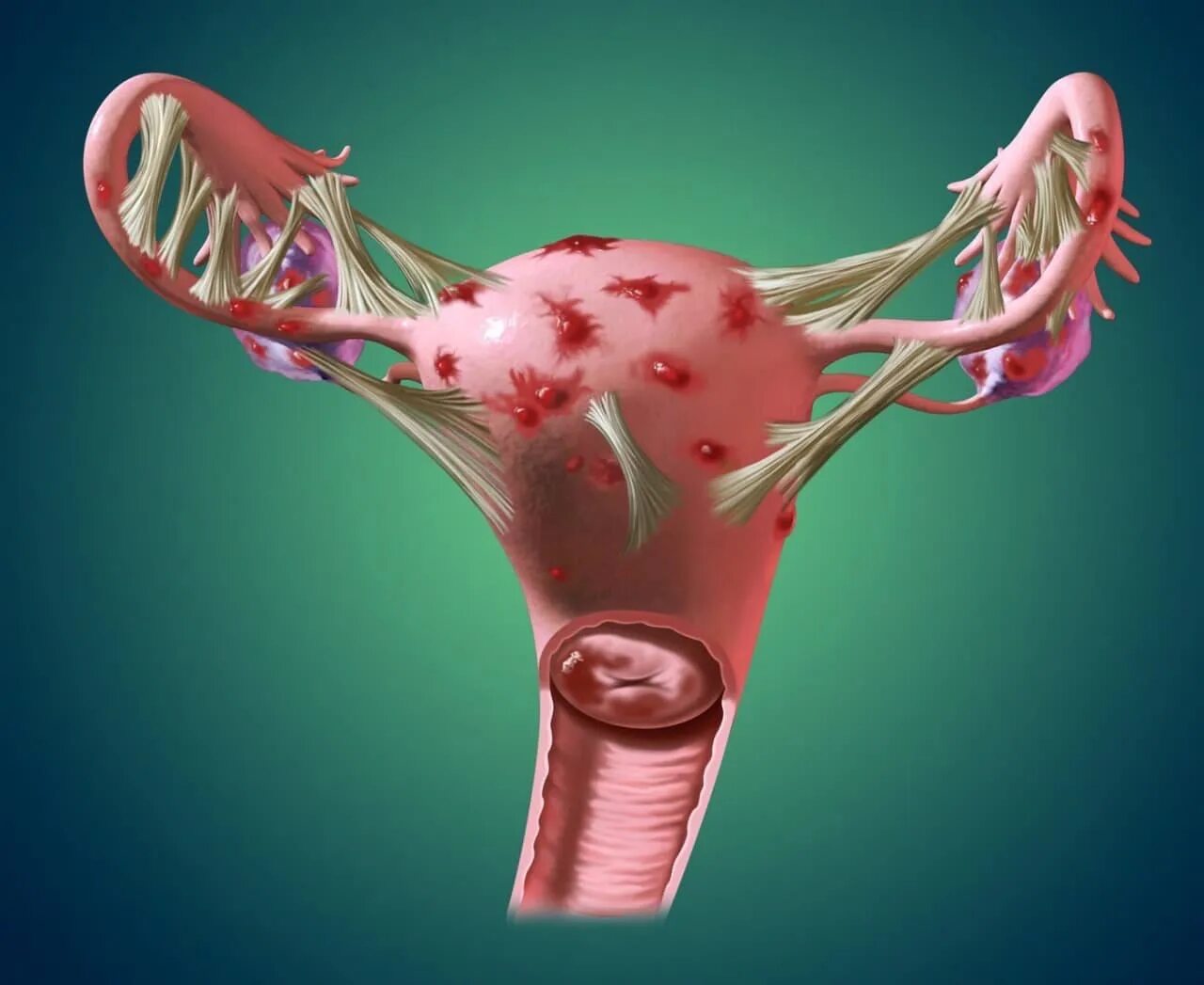 Месячные начинаются эндометрий. Эндометриоз фаллопиевых труб. Заболевание матки эндометриоз. Овариальный эндометриоз.