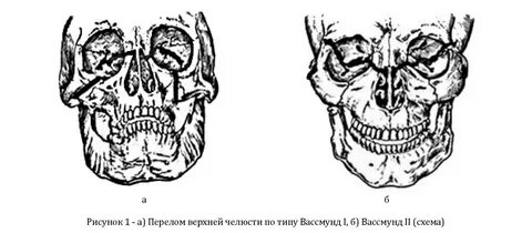 Сломана верхняя
