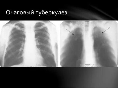 Начальная стадия туберкулеза у взрослых. Начальная стадия туберкулеза на снимке. Снимок начального туберкулеза. Туберкулез на ранних стадиях.