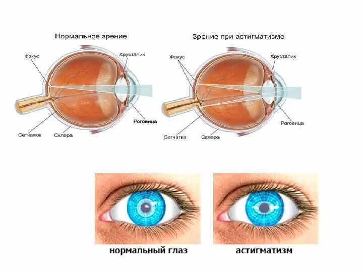 Миопия астигматизм глаз. Миопия гиперметропия астигматизм отличия. Близорукость дальнозоркость астигматизм. Миопия (близорукость) гиперметропия (дальнозоркость) астигматизм. Глаз с миопией астигматизмом.