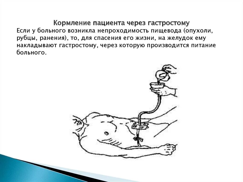 Кормление тяжелобольного через рот. Кормление пациента через гастростому. Показания для кормления через гастростому. Тяжелобольного кормление тяжелобольного пациента алгоритм. Кормление через гастростому алгоритм.