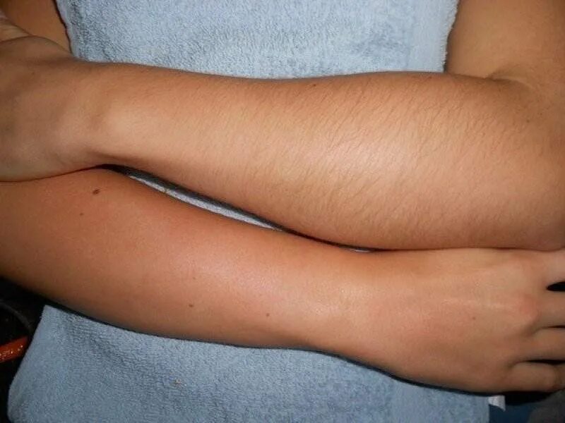 Лазерная эпиляция ног результат. Депиляция ног до и после. Депиляция ног до и после. Обесцвеченные волосы на руках. Лазерная эпиляция.