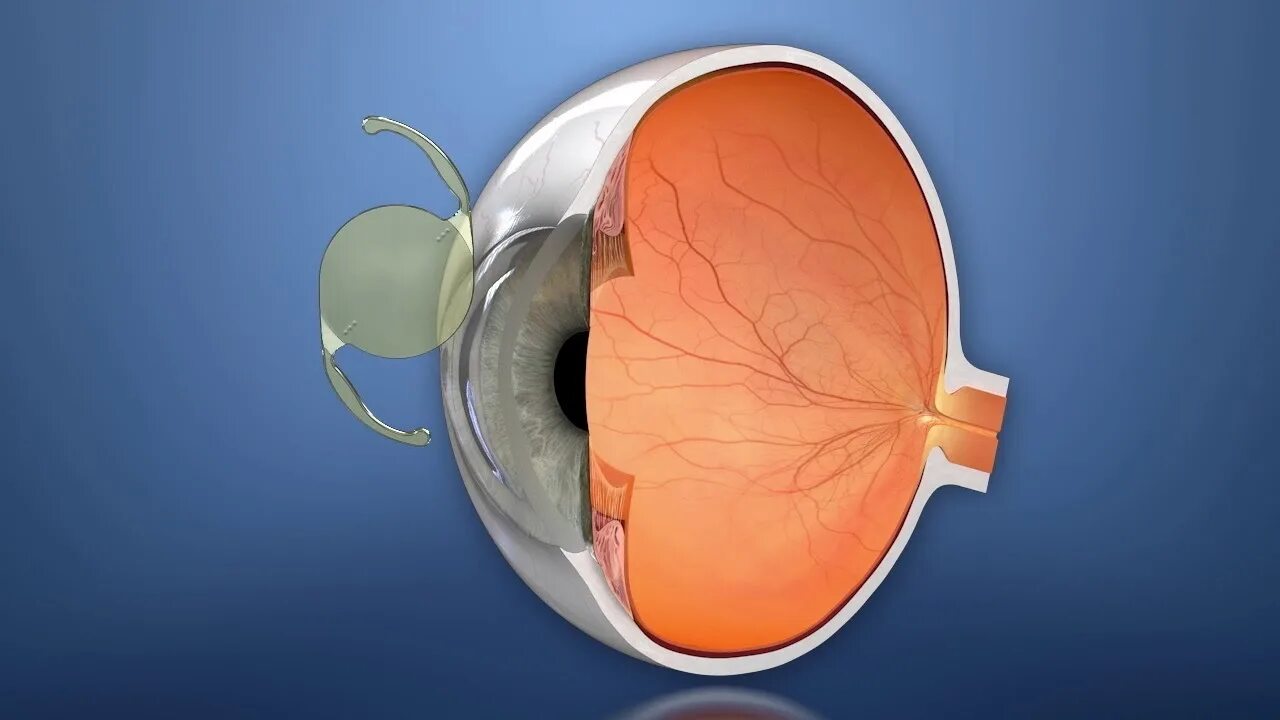 Роговица и хрусталик. Оптический срез хрусталика. Факичные интраокулярные линзы (иол). Материал хрусталика. Материал хрусталика.