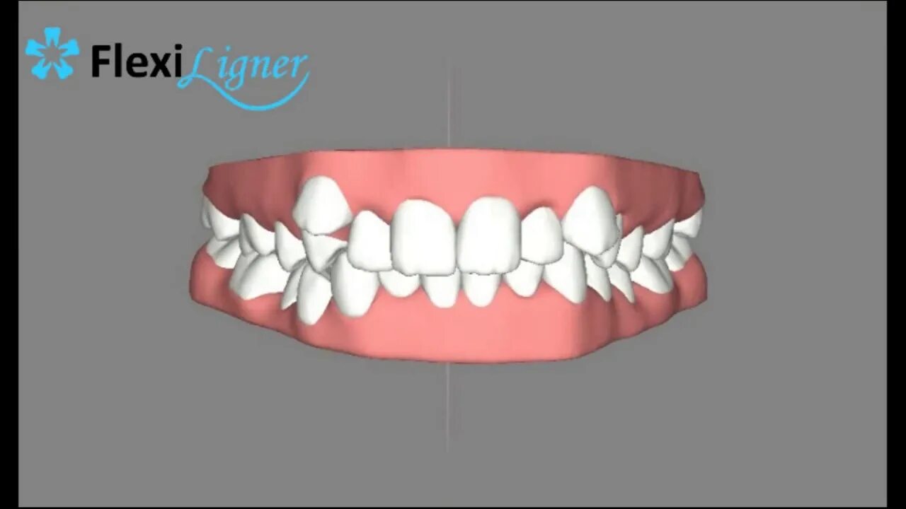 Флекси лайнеры элайнеры. Каппы флексилайнер. Детские элайнеры flexiligner. Флекс элайнеры. Каппы flexiligner.