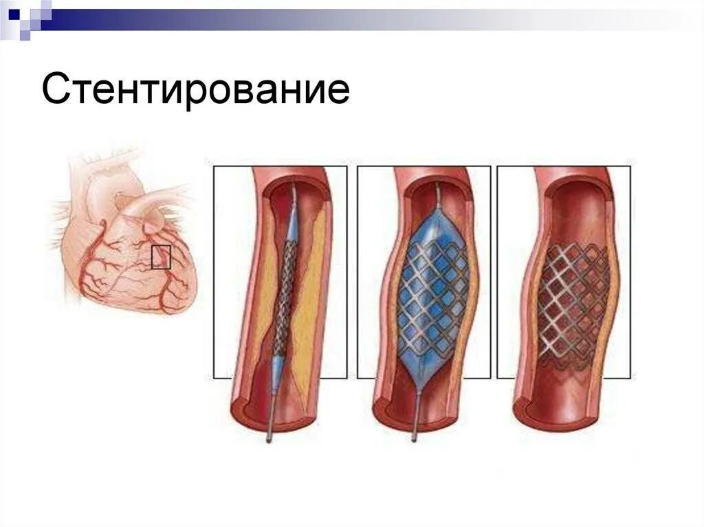 Стентирование после инфаркта миокарда. Транслюминальная ангиопластика. чрескожная транслюминальная коронарная ангиопластика. операция стентирование сосудов сердца. инфаркт миокарда операция стент.