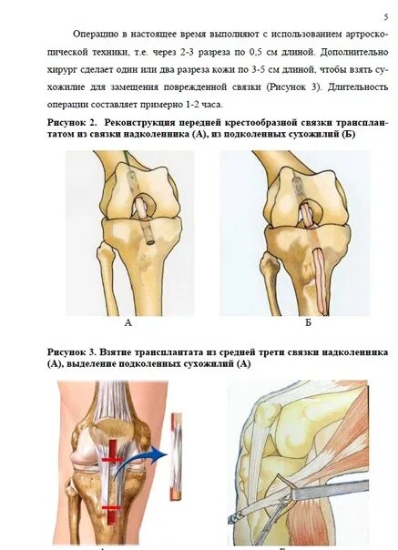 Реконструкция крестообразной связки коленного сустава. Реконструкция передней крестообразной связки коленного сустава. Артроскопическая реконструкция передней крестообразной связки.