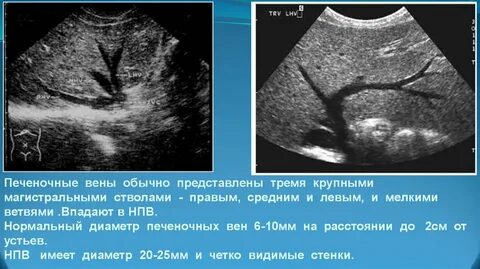 Расшифровка узи печени