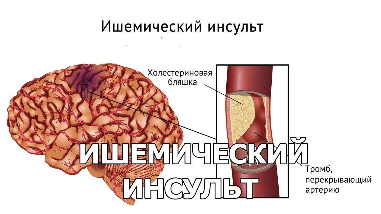 Ишемический инсульт возникает чаще при атеросклерозе. Ишемический инсульт картинки.